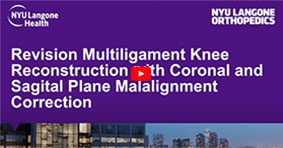 Revision Multiligament Knee Reconstruction with Coronal and Sagital Plane Malalignment Correction