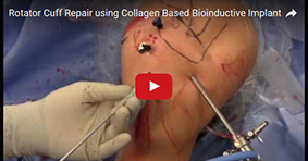 Rotator Cuff Repair using Collagen Based Bioinductive Implant