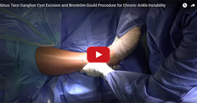 Sinus Tarsi Ganglion Cyst Excision and Broström-Gould Procedure for Chronic Ankle Instability