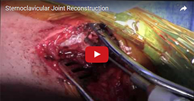 Sternoclavicular Joint Reconstruction