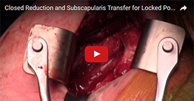 Closed Reduction and Subscapularis Transfer for Locked Posterior Shoulder Dislocation