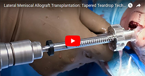 Lateral Meniscal Allograft Transplantation: Tapered Teardrop Technique