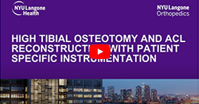 High Tibial Osteotomy and ACL reconstruction with Patient Specific Instrumentation