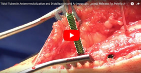 Tibial Tubercle Anteromedialization and Distalization and Arthroscopic Lateral Release for Patella A