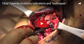 Tibial Tubercle Avulsion