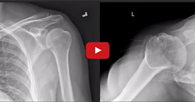 Arthroscopic Bony Bankart Repair for Acute Traumatic Shoulder Dislocation