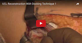 UCL Reconstruction With Docking Technique 1