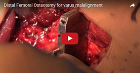Distal Femoral Osteotomy for Varus Malalignment