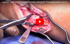 Lateral Talar Dome Osteochondral Allograft Transplantation via Fibular Osteotomy